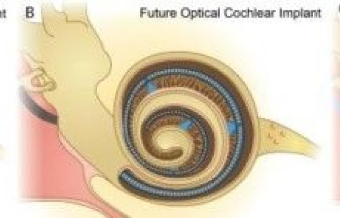 «سماع الضوء».. أمل جديد لفاقدي السمع