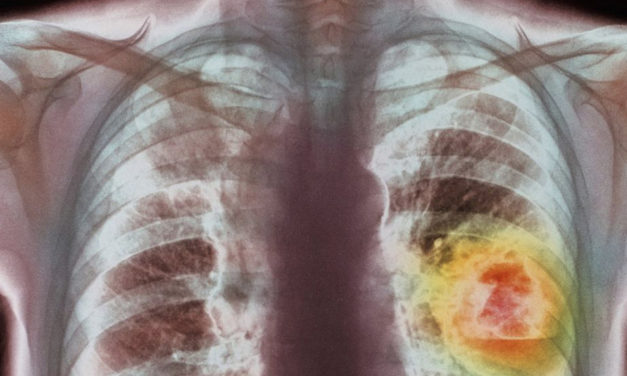 18.1 مليون حالة سرطان في العالم هذا العام