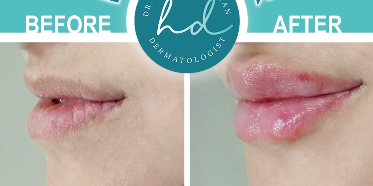 Give your lips a little of volume Center_Dr_Hosep_Demirjian