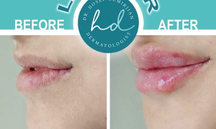 Give your lips a little of volume Center_Dr_Hosep_Demirjian