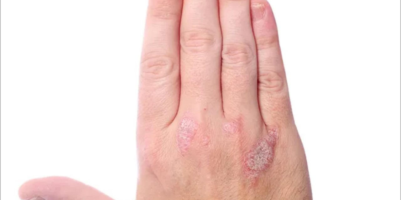 اكتشاف طريقة فعّالة لتقليل أعراض الصدفية