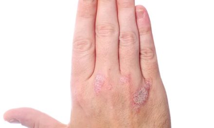 اكتشاف طريقة فعّالة لتقليل أعراض الصدفية